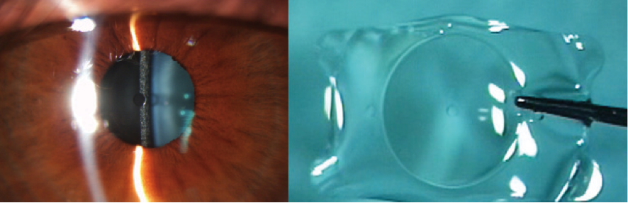 Lente Faquico Cirugia Refractiva Lente Intraocular Lentes Faquicos