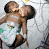 India: Nace un bebé con dos cabezas