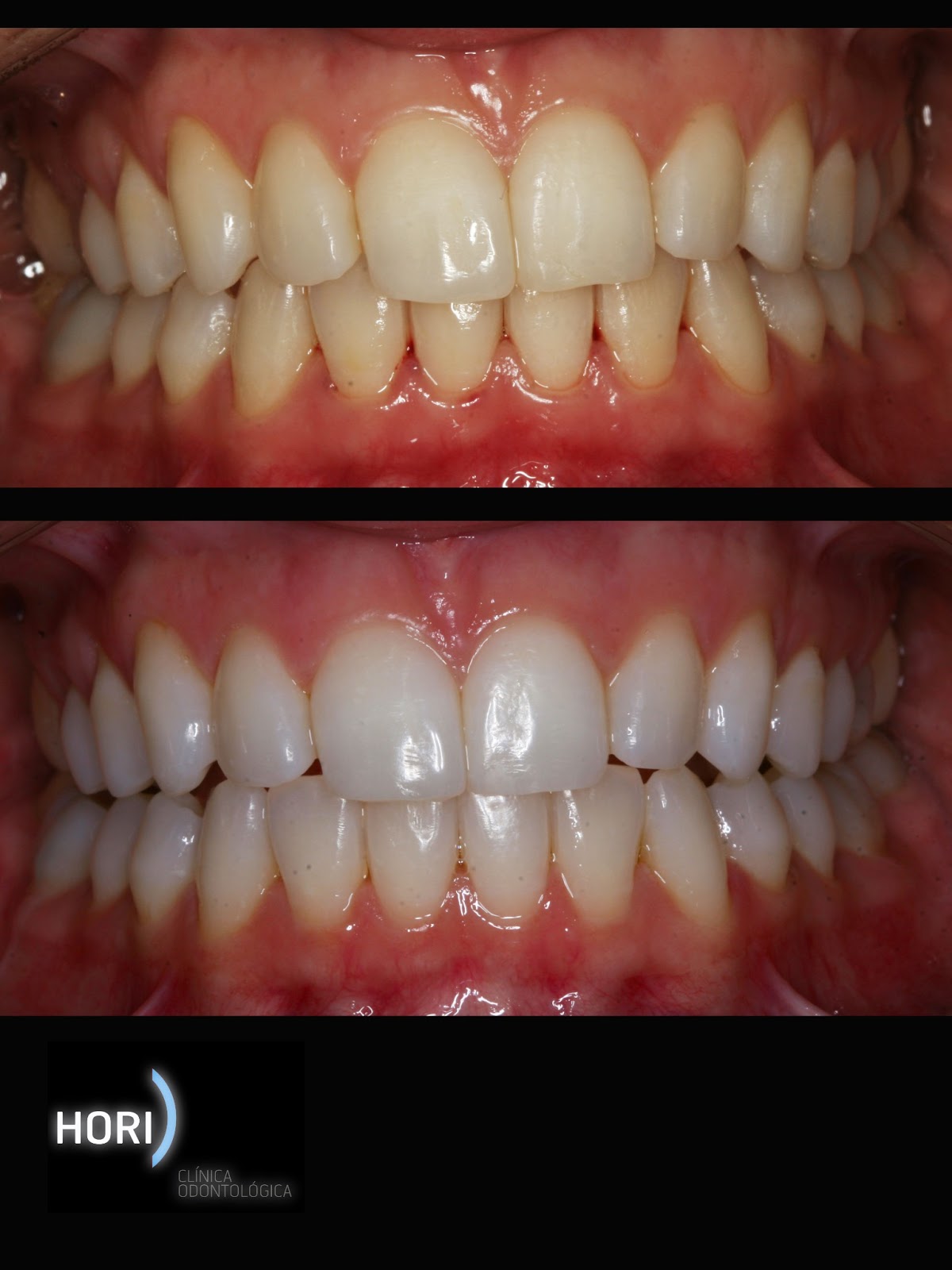 Dentista Guarulhos - Dra.Yeska Braga: Clareamento Dental Dentista Guarulhos - Dra.Yeska Braga: Clareamento Dental
