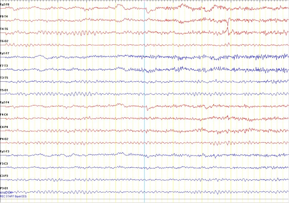 epilepsy eeg vs normal eeg epilepsy eeg vs normal eeg