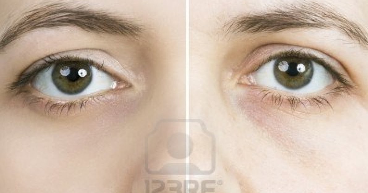 La desaparición de las pecas por el láser moskva el precio