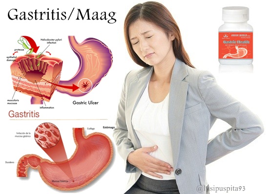 Penyakit Gastritis dan Cara Pengobatannya ~ Blog Kumpulan Tips Cara