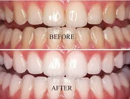 Change Yellow Teeth into Snow White in Just Five Minutes(Real Practical Proof 100% working).