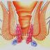 Obat Wasir Ibu Hamil thumbnail