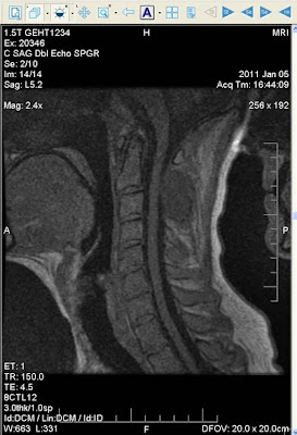 MRI of sarcoma tumor near spine and cervical vertebrae C1 C2 in neck