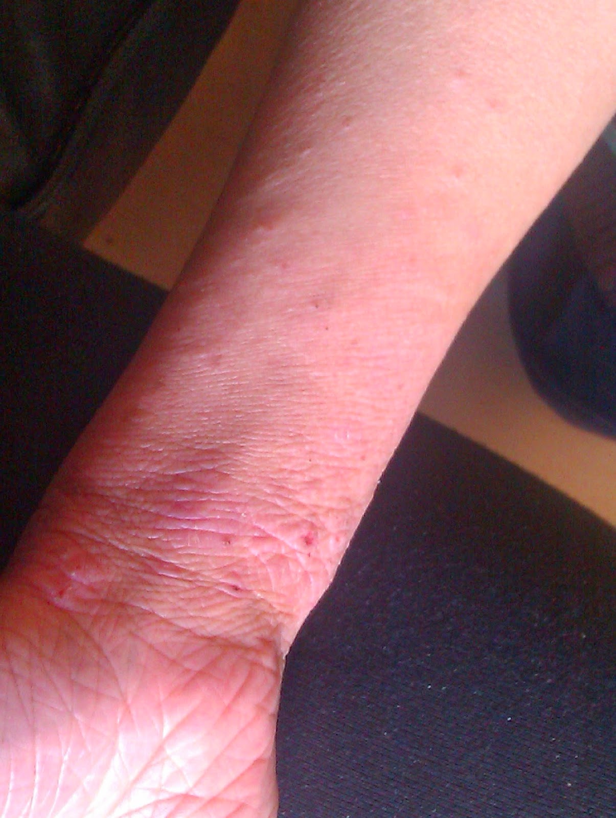 Steroids Make Eczema Worse April 2014