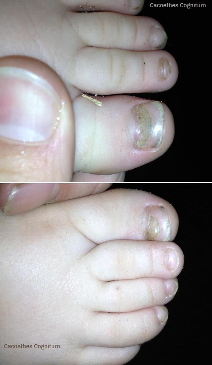 What do the spots on the nails in adults and children What do the spots on the nails in adults and children