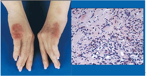 Health, Disease and Treatment: What Is Palindromic Rheumatism