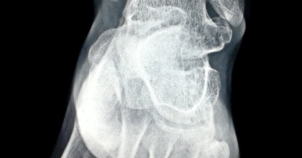 Clinical images Osteochondroma of the Left Talus