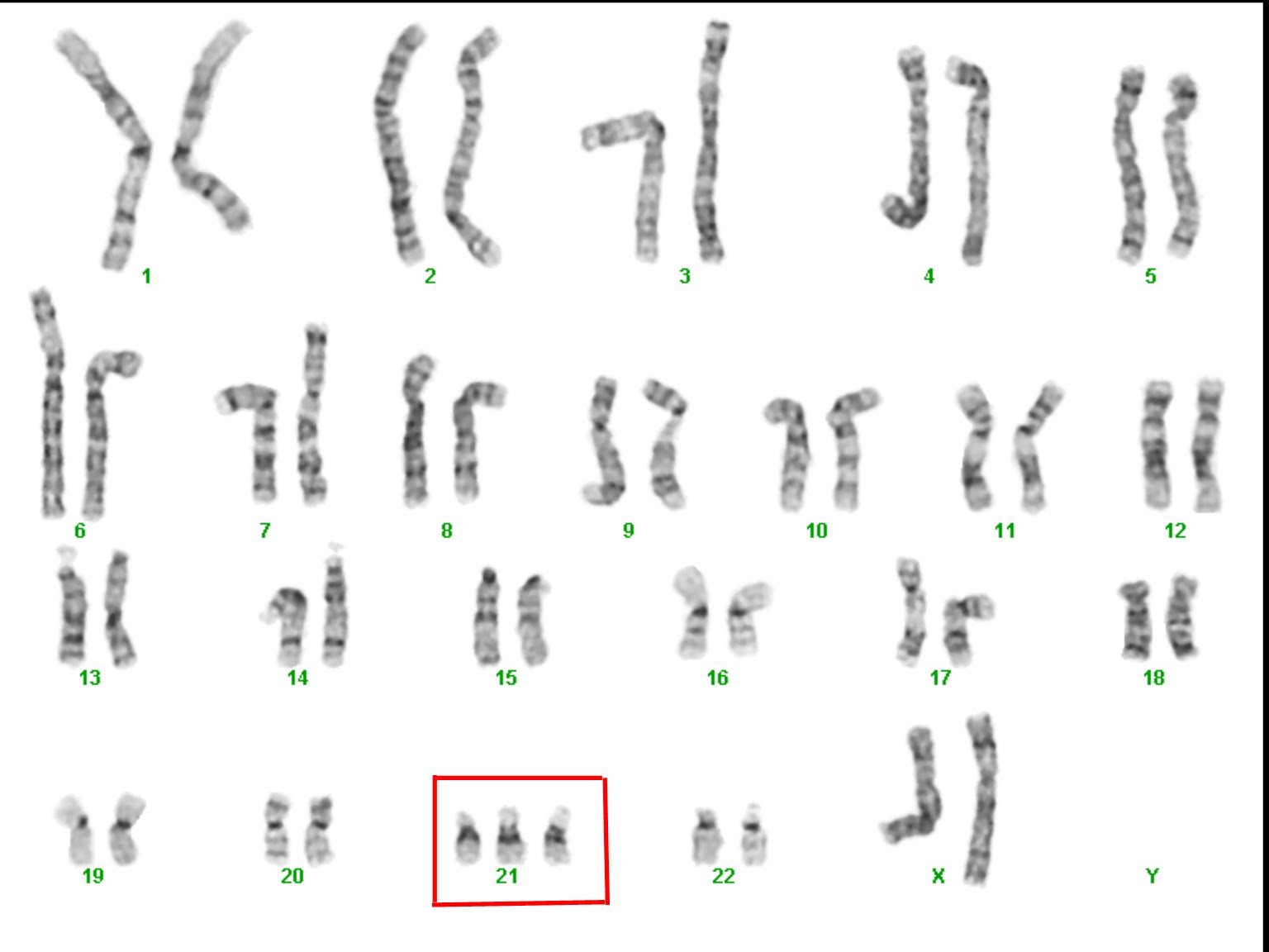 Chromosomes meiosis quizlet nondisjunction chromosome gamete Alec's Honors Biology Blog: Genetic Disorder: Down Syndrome
