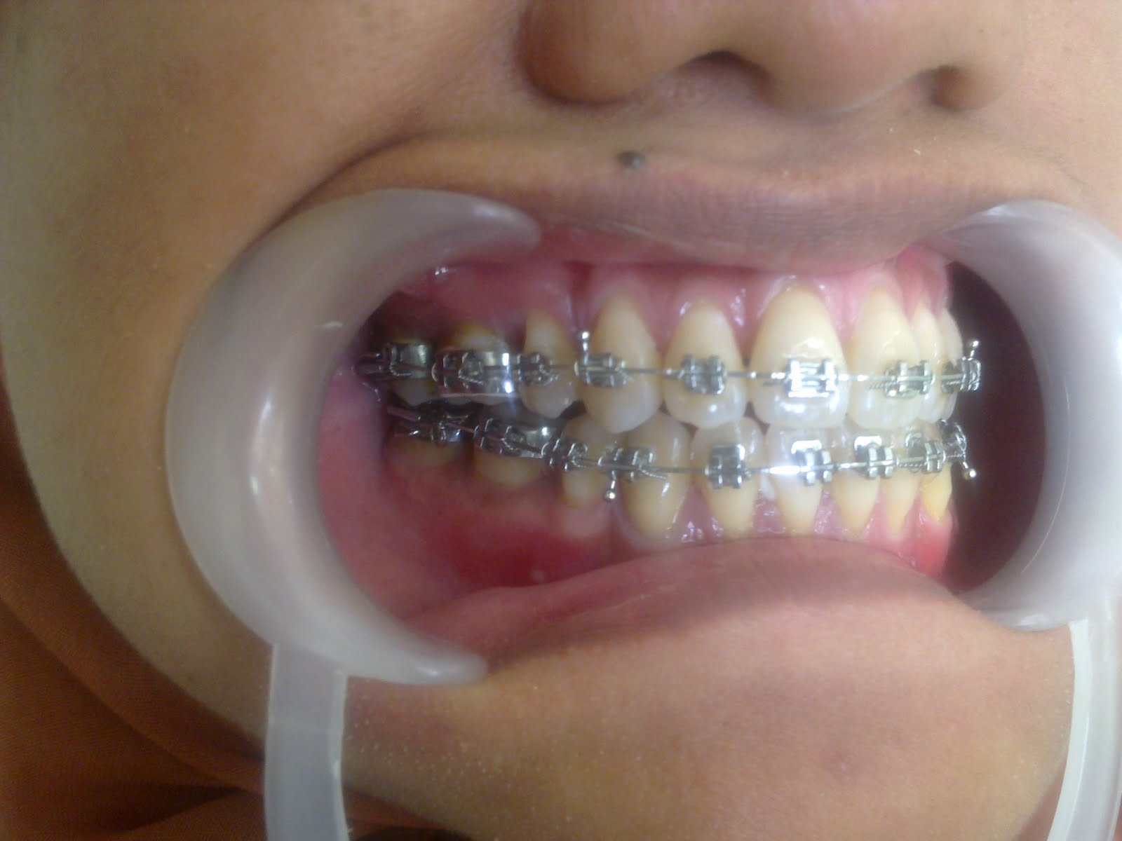 aryabrahmanta THE TREATMENT OF ANTERIOR OPEN BITE WITH EXTRACTION OF
