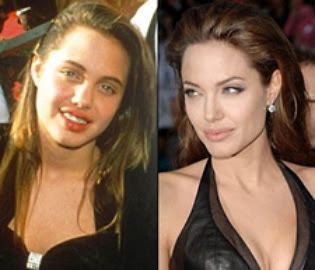 Plastic Surgery Before and After
