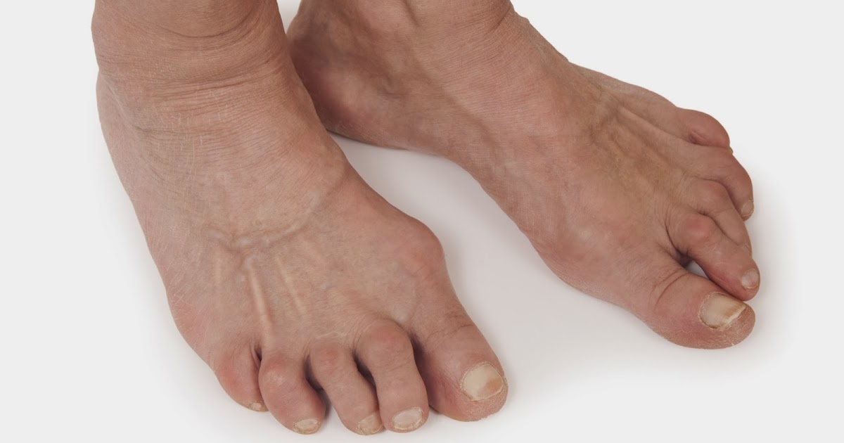arthritishq Rheumatoid Arthritis in Feet
