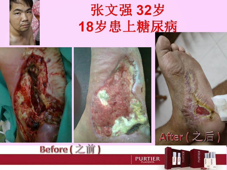 MR CHEONG (32 YEARS OLD) - DURING 18TH YEARS OLD WITH DIABETES SICKNESS