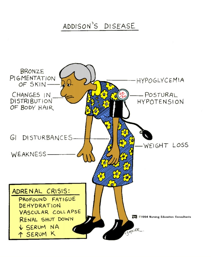 What are some signs of Cushing's disease?