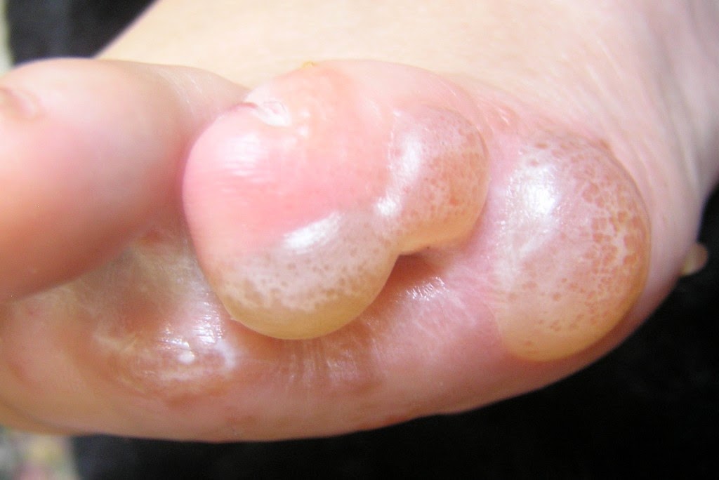 La máscara para el cuero cabelludo a la psoriasis