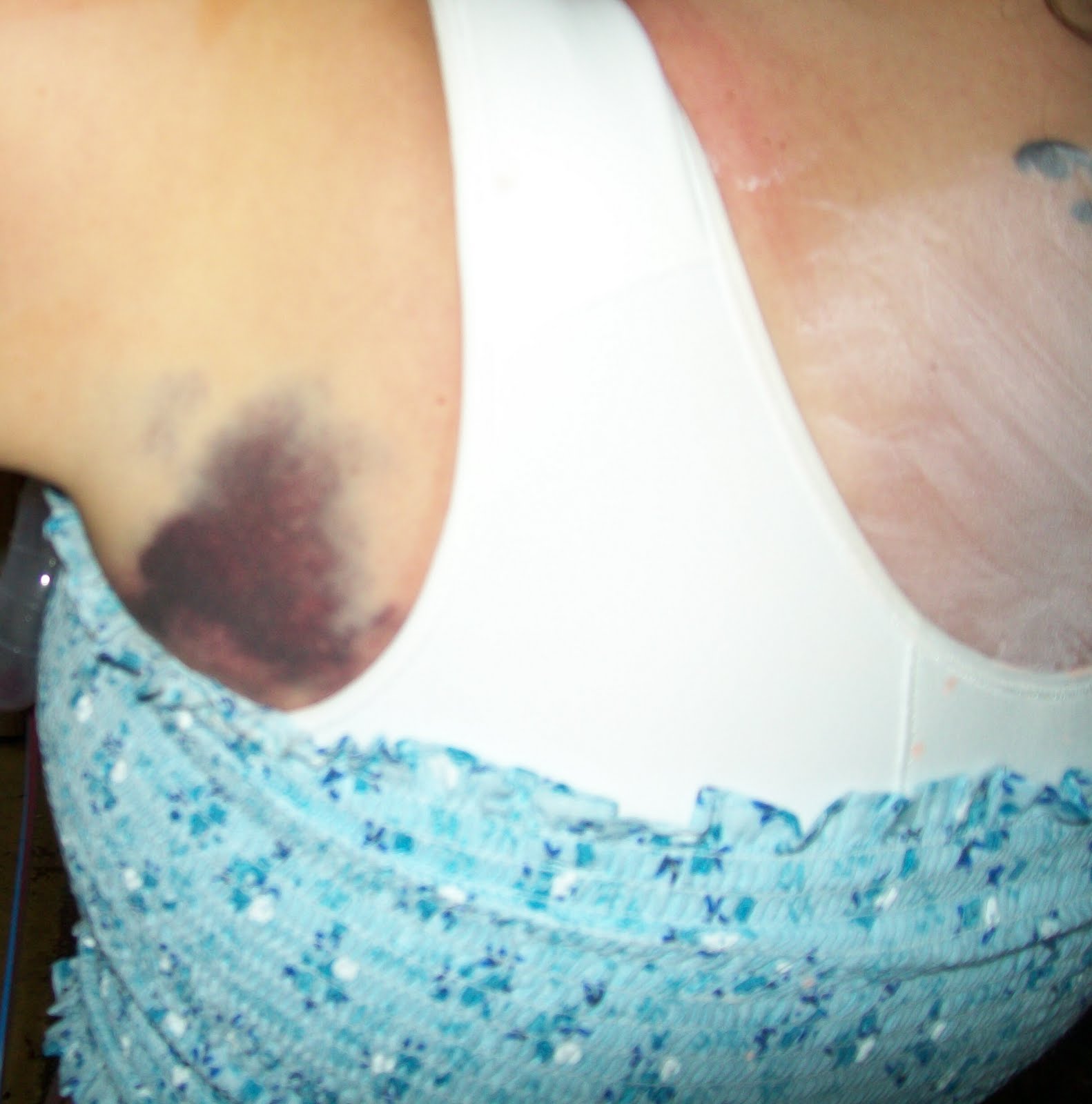 Breast reduction surgery photos