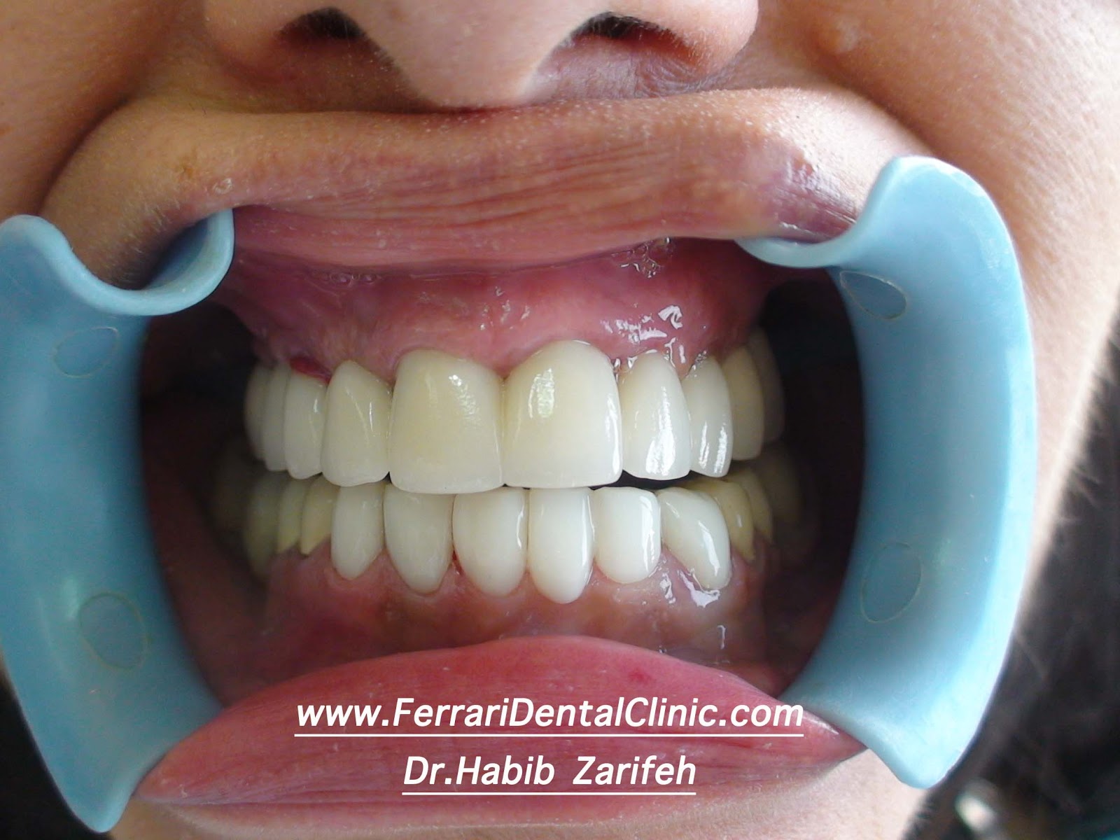 Dental implants Lebanon specialist Dr.Habib Zarifeh