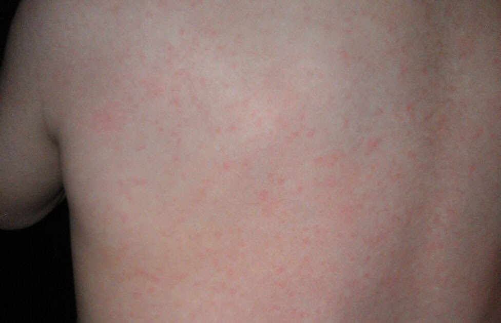 Lone Sunflower Utterly Confused with Food Allergies