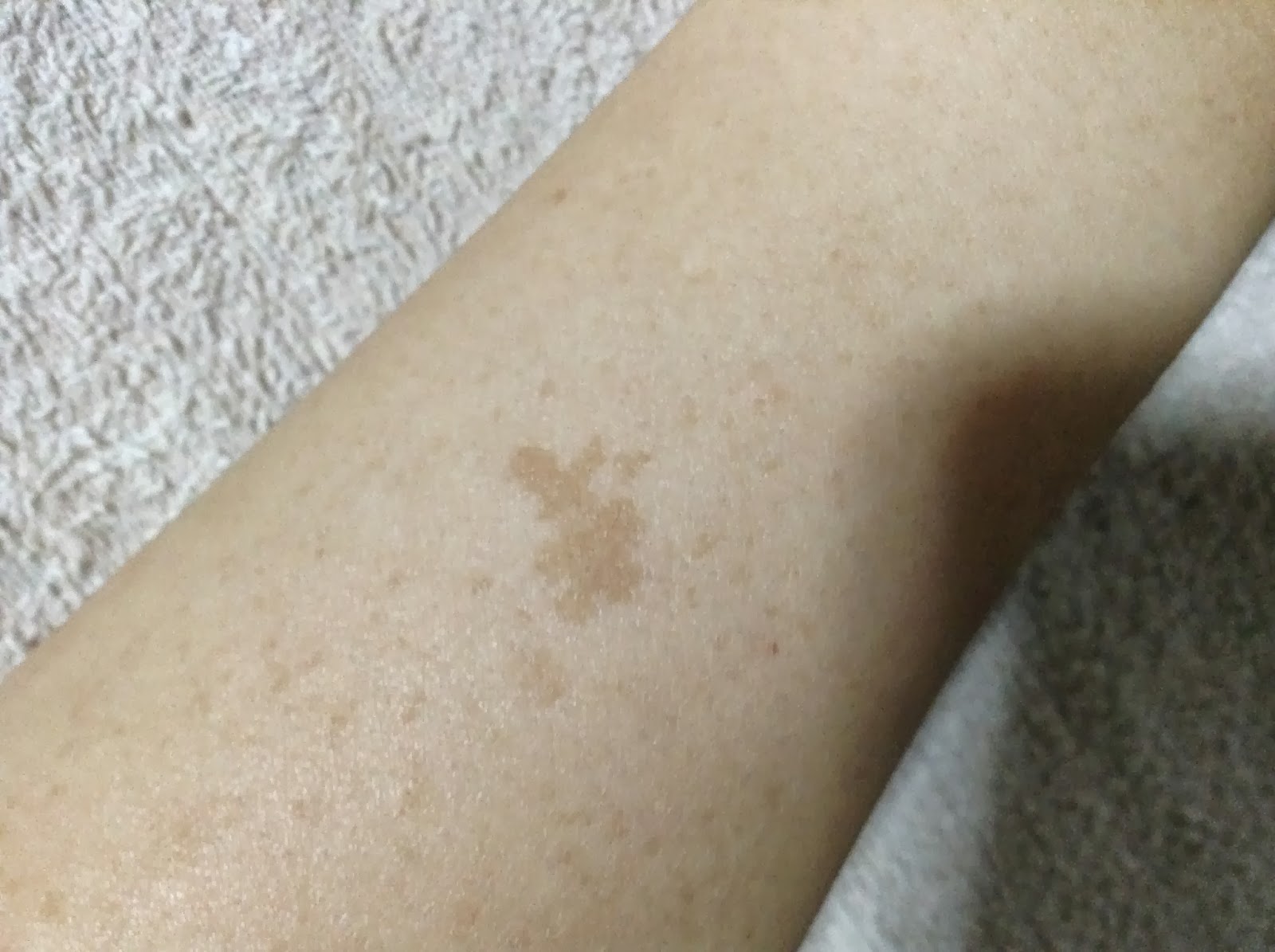 今日のセンスと明日のスタイル シミにお悩みの方へ これから検証スタート Hd ハイドロキノン スポットクリーム