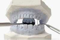 Price For New Teeth Price For New Teeth
