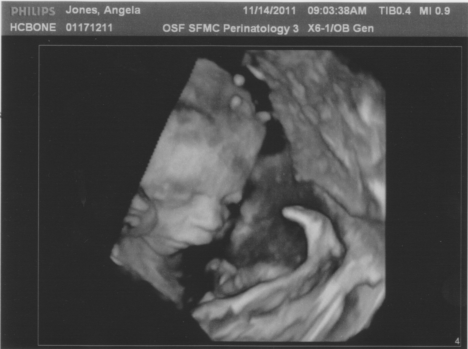 down syndrome 18 week ultrasound 4d down syndrome 18 week ultrasound 4d