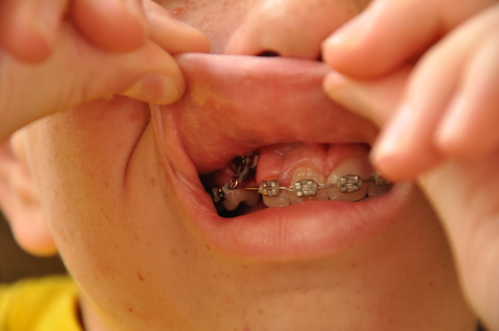 McGannTribe Blog You Don't Need Another Hole in your Head