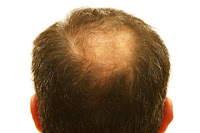 male hair loss treatments