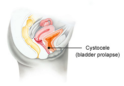 Bladder Prolapse Symptoms