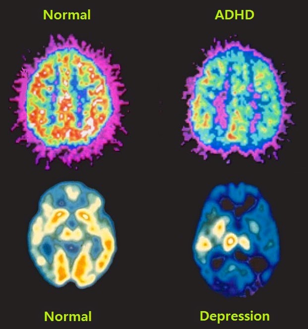 ADHD and Depression ADHD and Depression