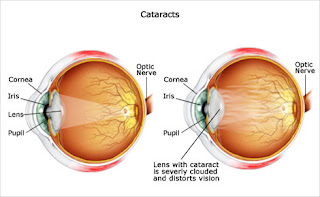 bright eyes cataract