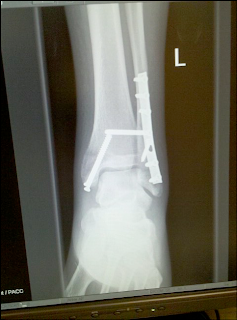 xray with hardware