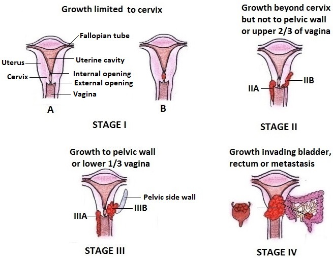Would take vulva cancer symptoms and side effects home from