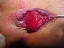 obat wasir ambeien paling ampuh obat wasir ambeien paling ampuh