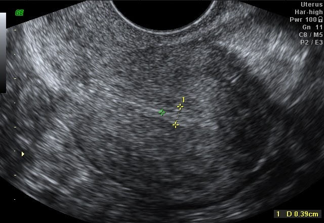 Dr.Malpani's Blog: How to improve a poor uterine lining