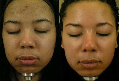 Before and After Dermamelan Treatment