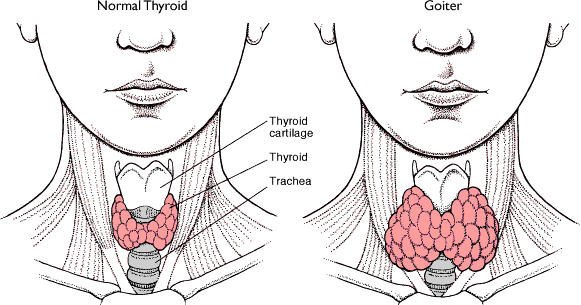 Beberapa Penyakit Yang Menyebabkan Hipertiroid Pathway
