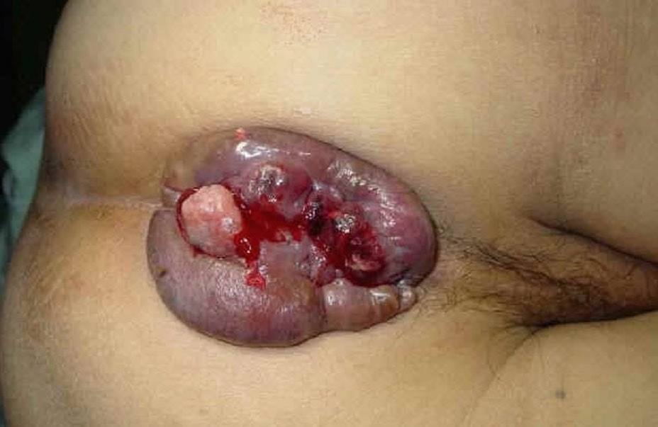 herpes in anus naked black sexy teens with huge boobs