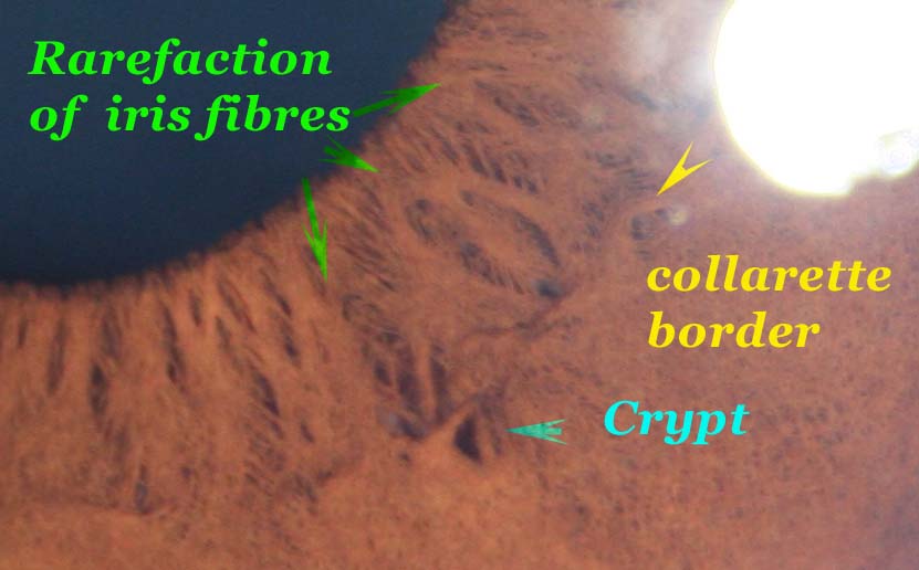 Modern &amp; Multidimensional Iridology: Crypts, Internal Lacunae
