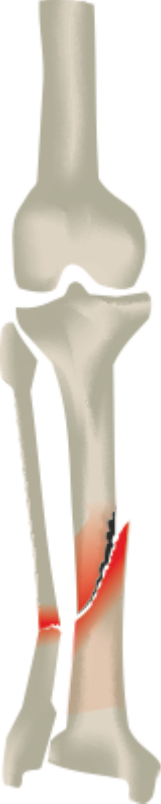 tibia and fibula fracture tibia and fibula fracture