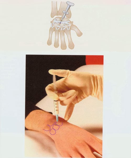 Wrist Joint Injection Nursing