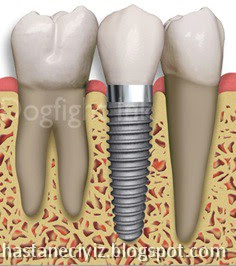 implant diş