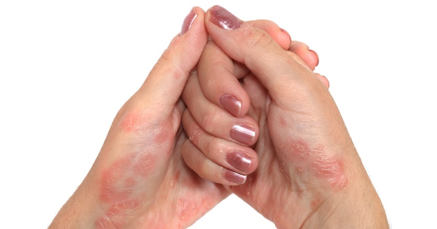 La psoriasis el tratamiento de la casa rápidamente