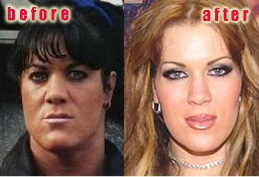 SEARCH AND BUY THIS PRODUCT Chyna Doll Plastic Surgery Before and After Eyelid Surgery