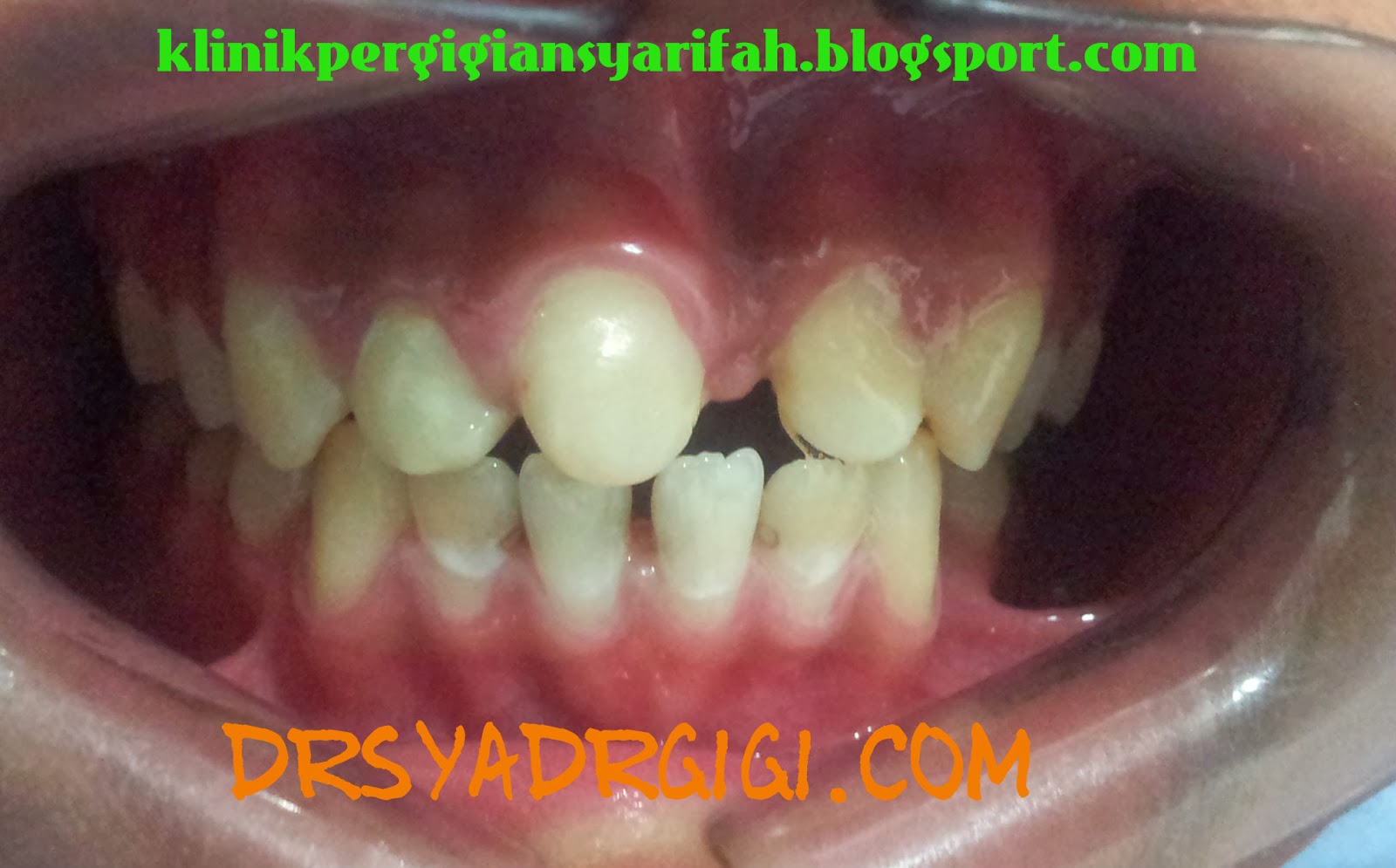 Klinik Pergigian Syarifah Penggantian Gigi Yang Hilang Secara
