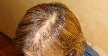 Se i capelli rapidamente diventano rimedi di gente grossi