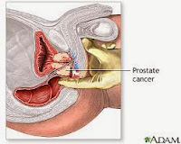 cáncer próstata,diagnostico de cancer de prostata,diagnostico cancer de prostata,cancer de prostata diagnostico,diagnostico cancer prostata,diagnostico de prostata,cancer