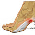 Home remedies for Heel Pain (एड़ी दर्द के लिए घरेलू उपचार)