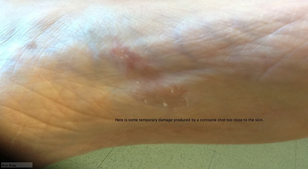 Foot and Ankle Problems By Dr. Richard Blake Cortisone Shots Avoid