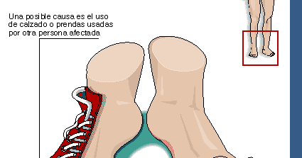 Como curar el hongo de las uñas por 9 vinagre